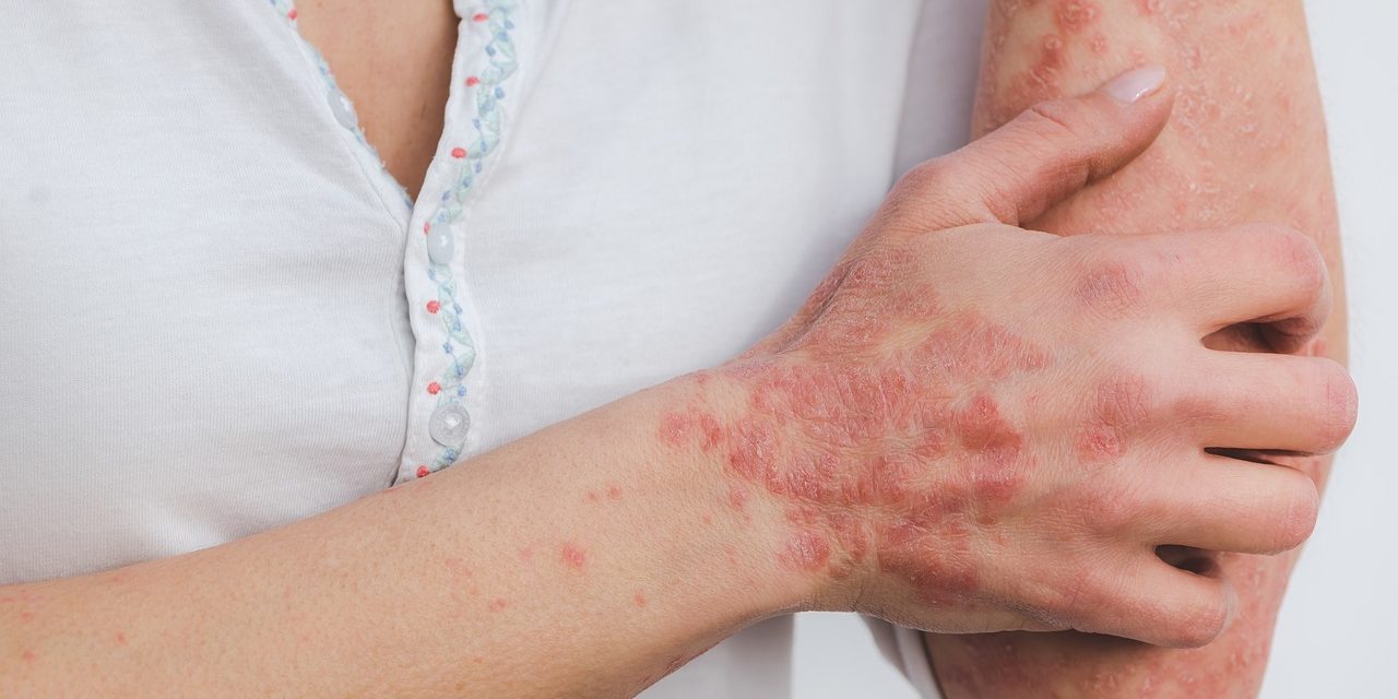 psoriasis et cbd psoriasis et cbd