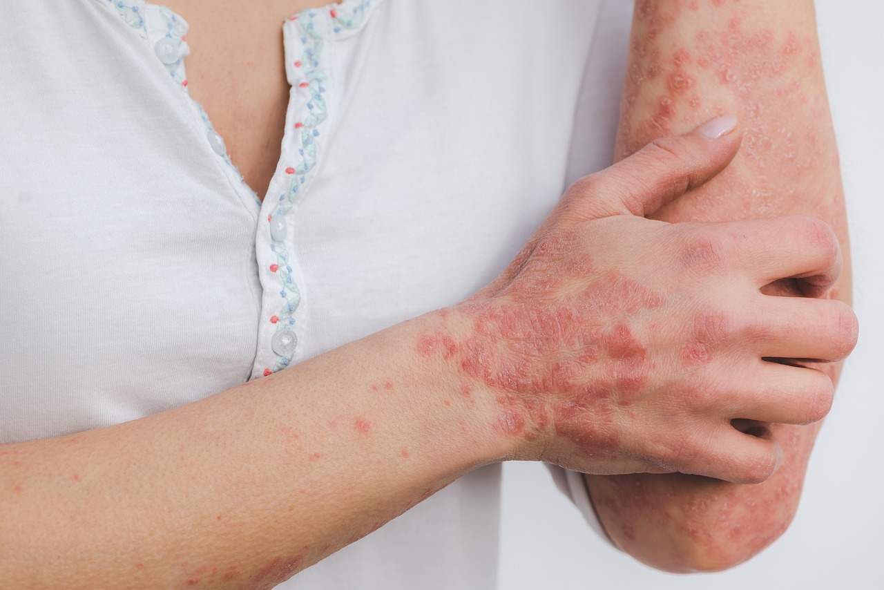 psoriasis et cbd