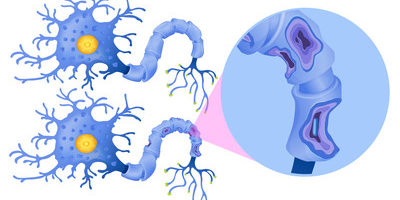 sclerose en plaque sclérose en plaque