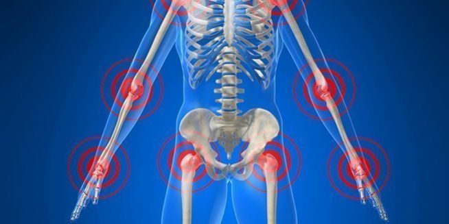 polyarthrite rhumatoide polyarthrite rhumatoide