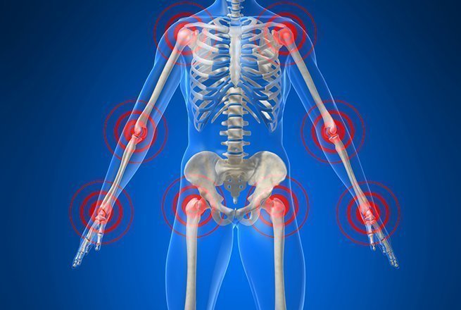 polyarthrite rhumatoide